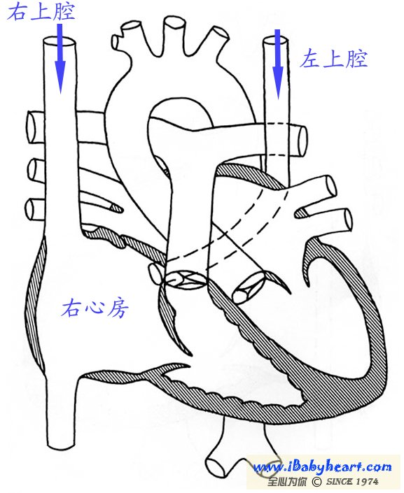 左上腔静脉残存算不算先心病?